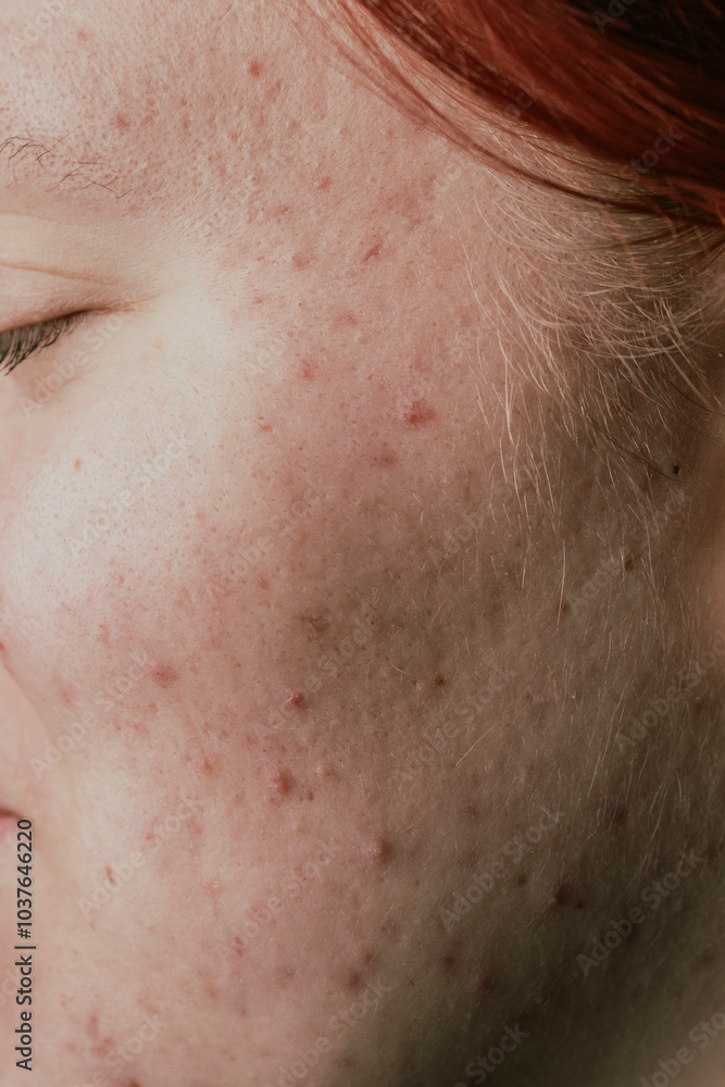 Pimples, pores, scars. Natural skin. Pimple or acne. Skin treatment. Medicine and cosmetology concept. Natural skin. Skin acne background. Closeup acne pimple. Treatment for acne. Problem skincare. Pimples, pores, scars. Natural skin. Pimple or acne. Skin treatment. Medicine and cosmetology concept. Natural skin. Skin acne background. Closeup acne pimple. Treatment for acne. Problem skincare.