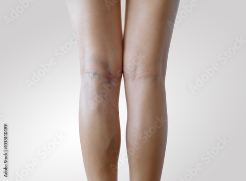 Fotografía Beautiful slender woman with sign of varicose veins symptoms on a legs