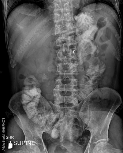 Abdominal radiograph showing a barium examination of the bowel after 2 hours