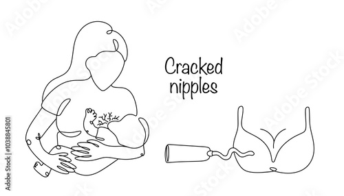 Cracked nipples