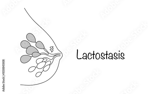 Lactostasis