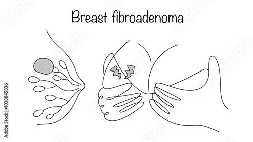 Breast fibroadenoma