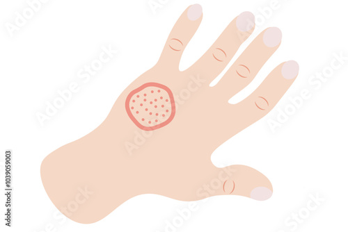 Autoimmune progesterone dermatitis,urticaria,Bullous pemphigoid,herpetiformis,Dermatomyositis,Epidermolysis bullosa acquisita,Gestational,Hidradenitis suppurativa,Lichen planus,Linear