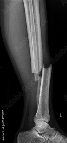 Slika na platnu Emergency x-Ray showing tibia and fibula fracture lateral radiograph