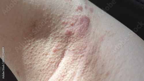 ringworm eczema infected on human body red rash ring on skin close up shot