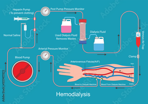 Hemodialysis access with an arteriovenous fistula.