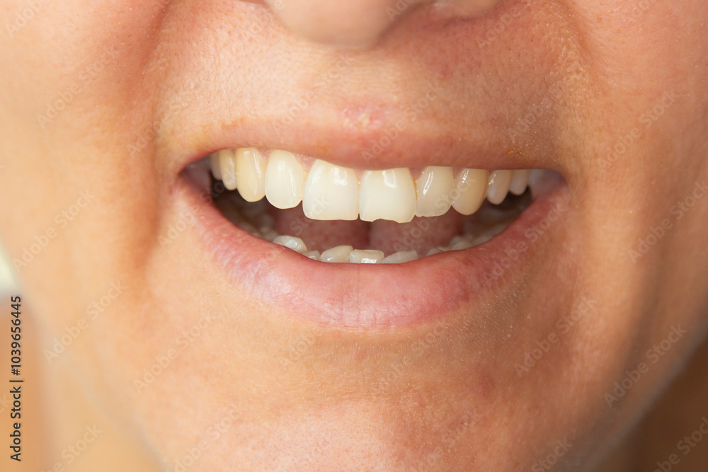 Fototapeta premium Close up of chipped tooth because of a bike accident