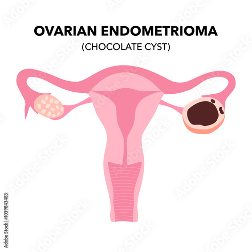 Chocolate cyst. Female ovarian endometrioma disease vector. Ovarian cyst with female reproductive system.