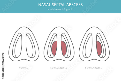 Nasal septal abscess. Nasal diseases. Medical infographic design. Vector illustration