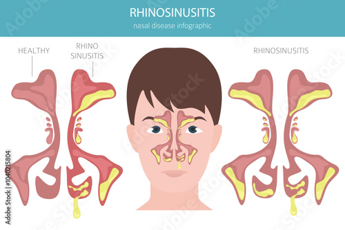 Rhinosinusitis. Nasal diseases. Sinusitis, sinus infection diagnosis and treatment medical infographic design. Vector illustration