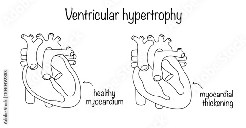 Ventricular hypertrophy