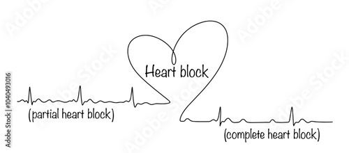 Heart block