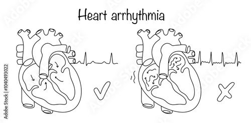 Heart arrhythmia