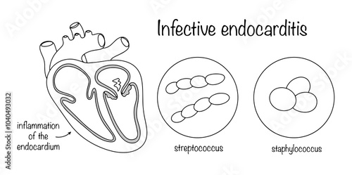 Infective endocarditis