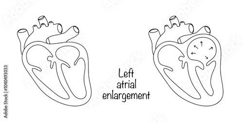 Left atrial enlargement