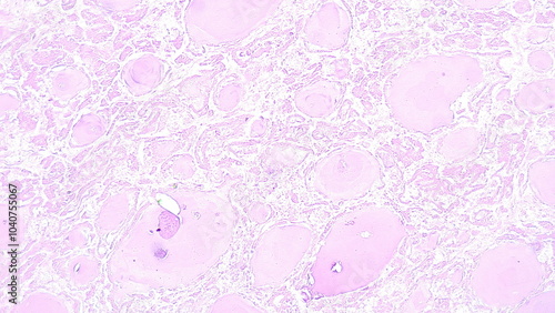 Photomicrograph showing histology of a benign thyroid nodule in a patient with multinodular goiter under microscope in pathology laboratory photo