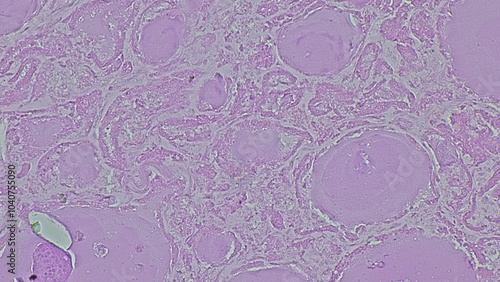 Photomicrograph showing histology of a benign thyroid nodule in a patient with multinodular goiter under microscope in pathology laboratory photo