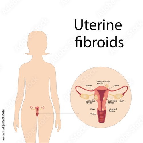 Vector illustration of uterine fibroids. Gynecological problem. Tumor of female reproductive organ
