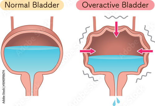 Overactive bladder