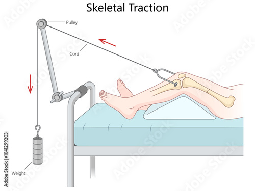 skeletal traction using weights and pulleys to align a leg fracture, showing the mechanism components and setup hand drawn schematic vector illustration. Medical science educational illustration