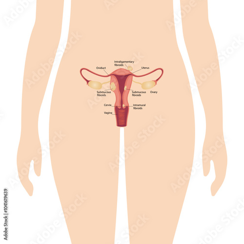 endometriosis, uterine fibroids, gynecological cancer, subserous fibroids and cervical, vaginal