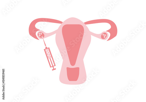 IVF stage, egg puncture, oocyte collection, IVF - vector, flat color illustration