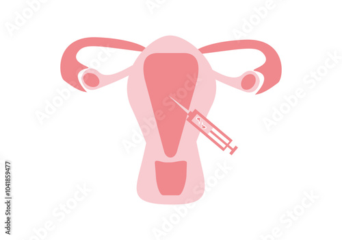 IVF stage, embryo transfer into uterine cavity, IVF - vector, flat schematic color illustration