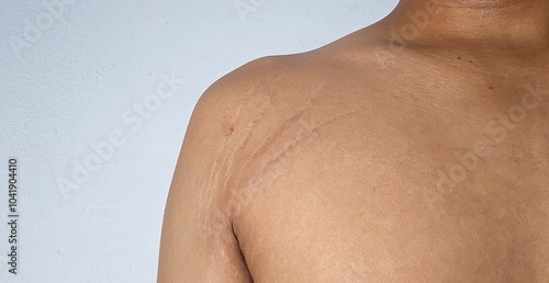 stretch marks on armpit skin area	
