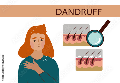 Young woman with dandruff problem. Symptoms, infographic, treatment.Health medicine, trichology, dermatology concept. Vector hand drawn flat cartoon illustration.