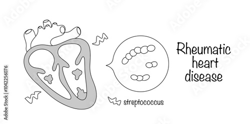 Rheumatic heart disease