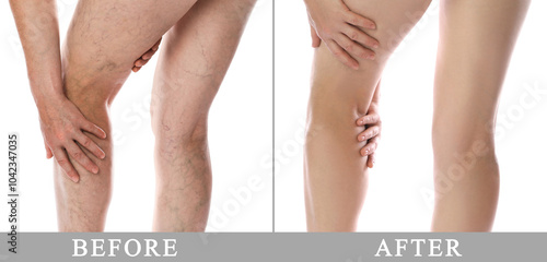 Varicose veins treatment. Woman showing legs on white background, closeup. Before and after collage