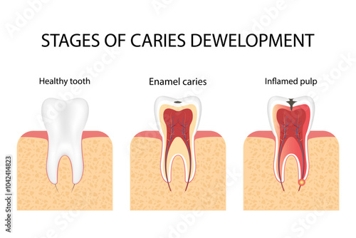 Types of caries in humans. Superficial, median, deep caries., and pulp