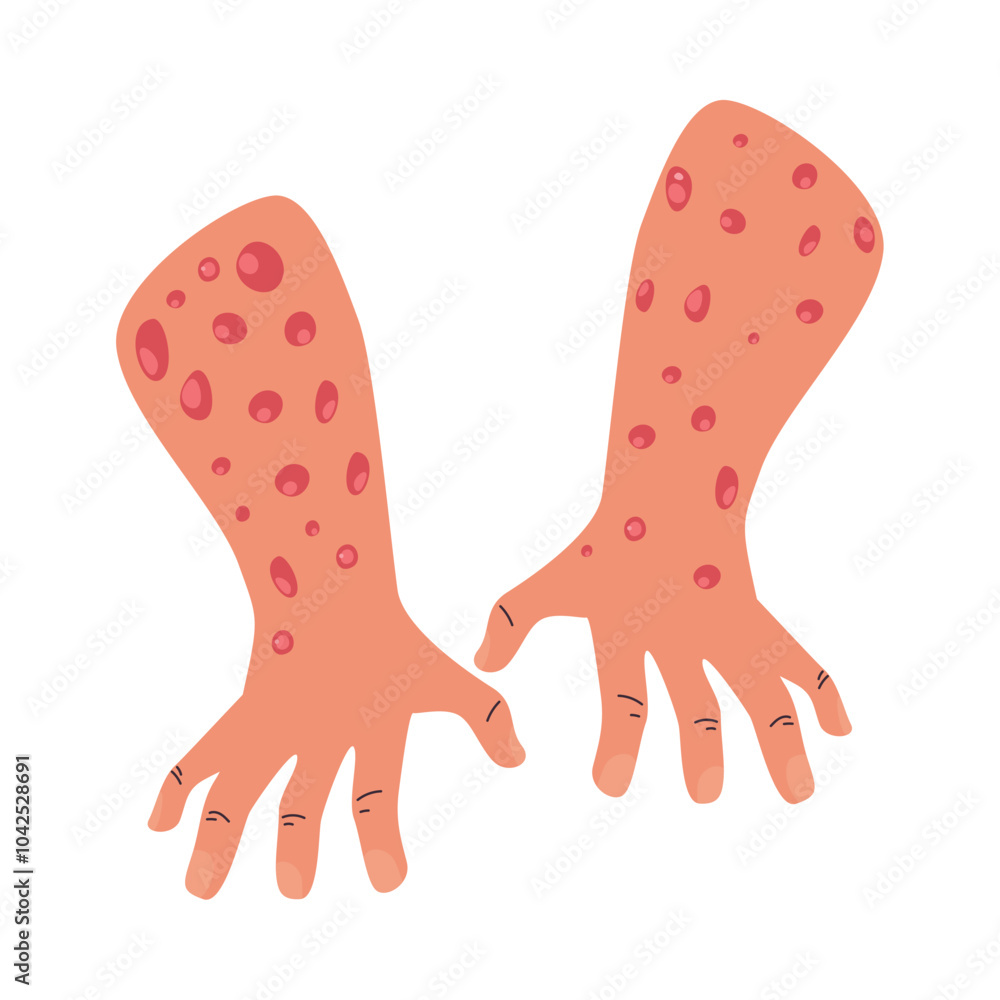 human hands with monkeypox virus human hands with monkeypox virus