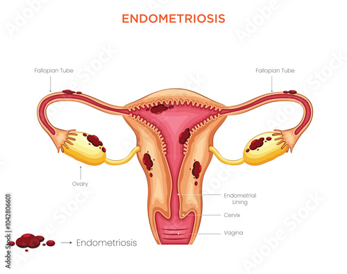 Understanding Endometriosis Causes, Symptoms, and Treatment