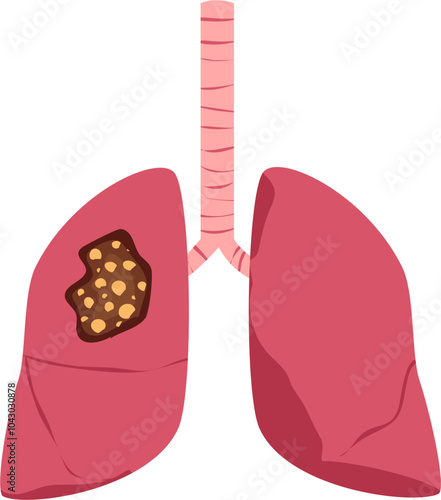 Lung disease. Respiratory disease illustration.