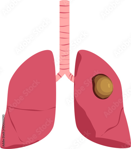 Lung disease. Respiratory disease illustration.