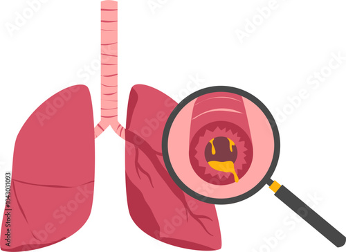 Lung disease. Respiratory disease illustration.