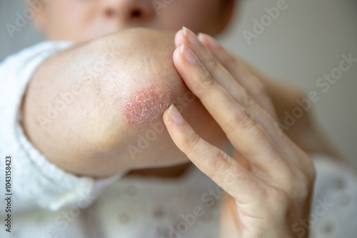 Close-up of a person touching a red, dry patch of skin on their elbow, showing signs of psoriasis or eczema, highlighting a skin condition that requires treatment or care. photo