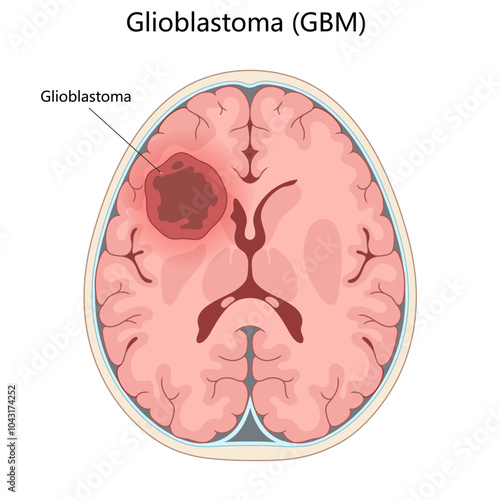 cross-section of the brain with a labeled glioblastoma tumor, highlighting its location and severity diagram hand drawn schematic vector illustration. Medical science educational illustration