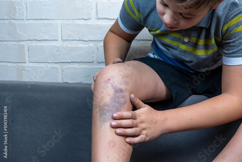Foto Child showing large painful bruise on leg from injury