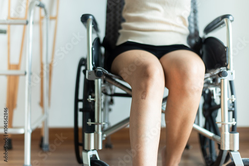 Patient woman with scar on leg,Dry skin scab .