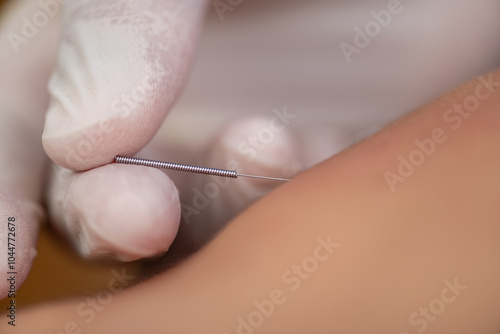 Physical therapist performing dry needling on a patient's back to target muscle knots, reduce pain, and improve mobility through precise trigger point stimulation