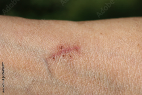 Close-up of arm of elderly woman with healed wound against green grass background photo