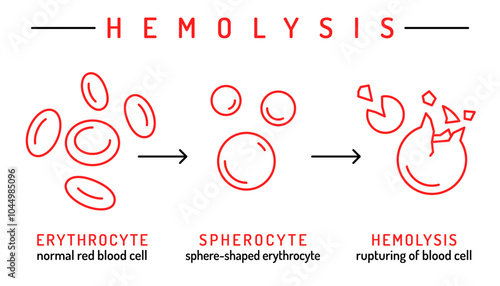 Hemolytic anemia infographic. Vector illustration isolated on a white background
