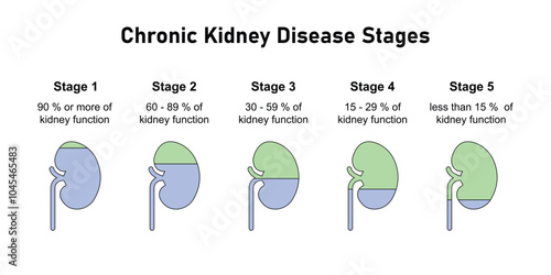 Chronic Kidney Disease (CKD) Stages Scientific Design. Vector Illustration.
