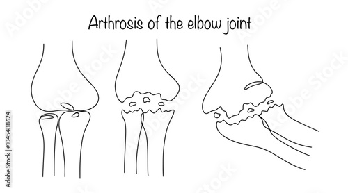 Arthrosis of the elbow joint