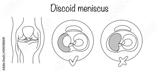 Discoid meniscus