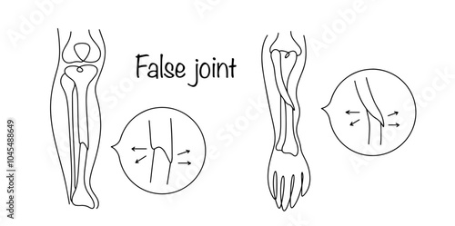 False joint