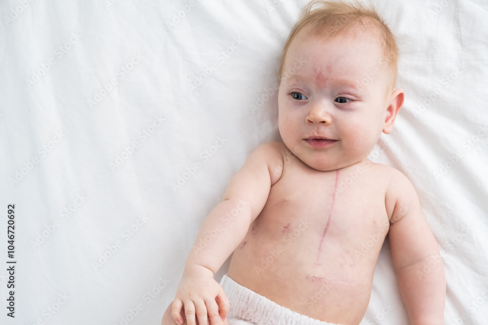 little girl with a scar from heart surgery little girl with a scar from heart surgery