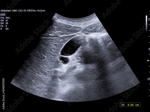 Ultrasound scan of the upper abdominal region showing several small gallbladder polyps, perfect for use in diagnostics and educational content on gallbladder conditions.